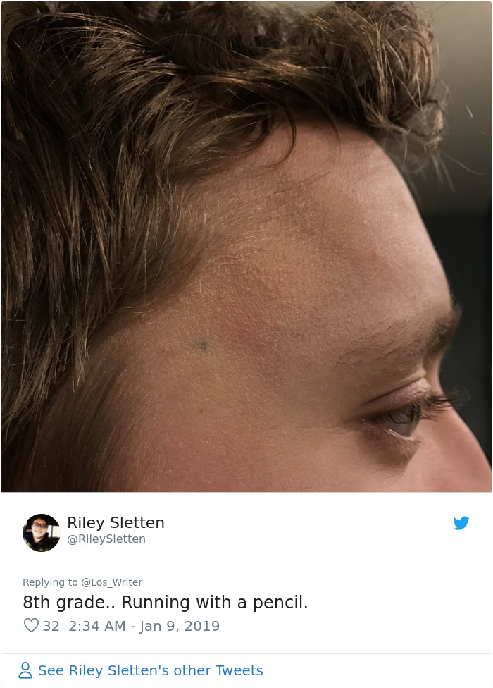 Apparently, Pencil Scars Are A Thing And There Are More People Affected Then You Would Think Apparently, Pencil Scars Are A Thing And There Are More People Affected Then You Would Think