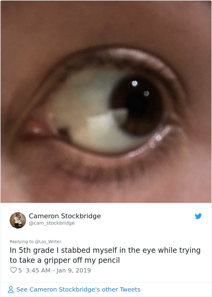 Apparently, Pencil Scars Are A Thing And There Are More People Affected Then You Would Think Apparently, Pencil Scars Are A Thing And There Are More People Affected Then You Would Think