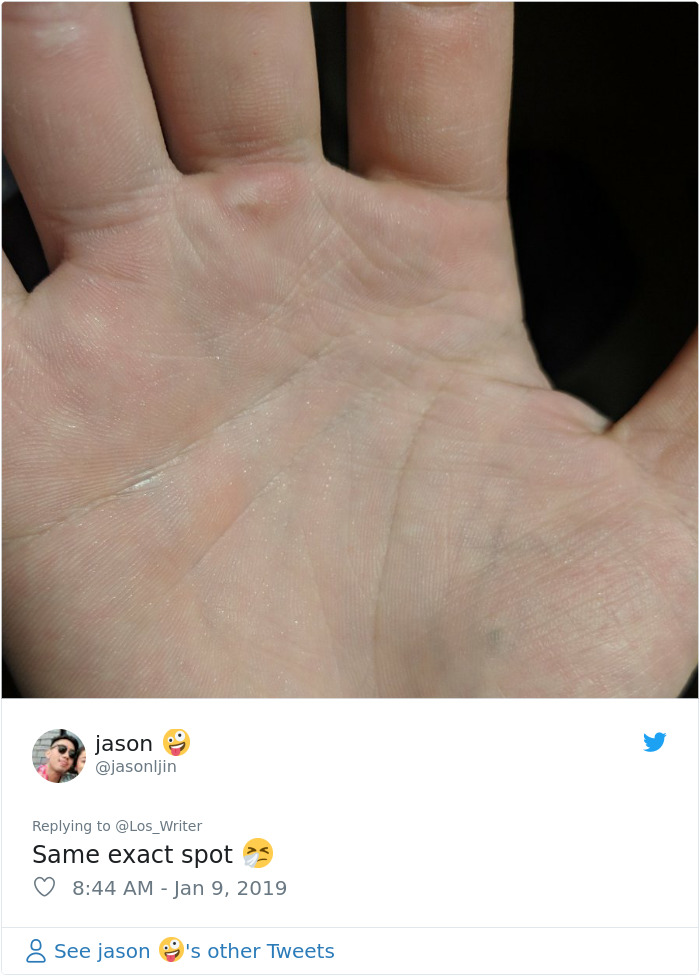 Apparently, Pencil Scars Are A Thing And There Are More People Affected Then You Would Think Apparently, Pencil Scars Are A Thing And There Are More People Affected Then You Would Think