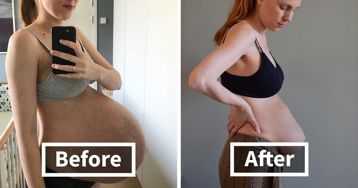 Woman Who Stunned The World With Her Huge Baby Belly, Shows What Giving Birth To Triplets Does To Your Body