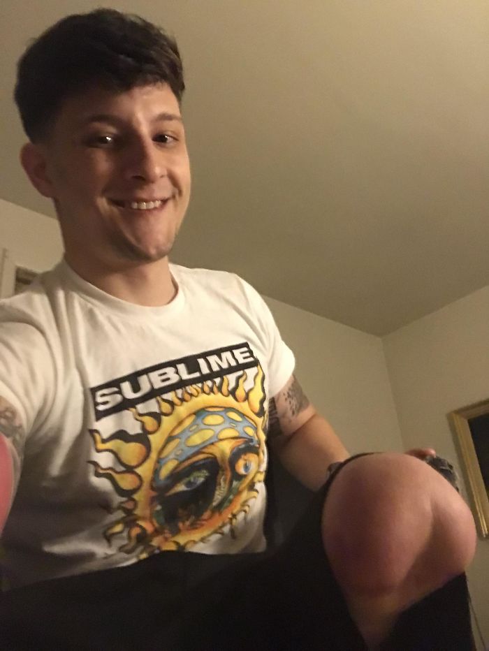 My Amputated Leg Looks Like A Butt