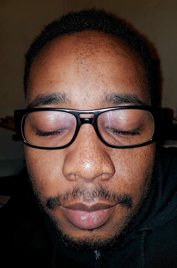 My Boyfriend Has Freckles On Only Half Of His Face, I Think It's Cool