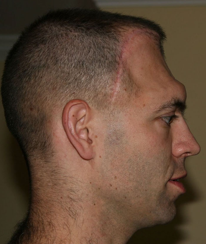 Guy Who Was Supposed To Live For 6 Years After Brain Cancer Diagnosis, Lives For 20+ Years, Beats It 4 Times