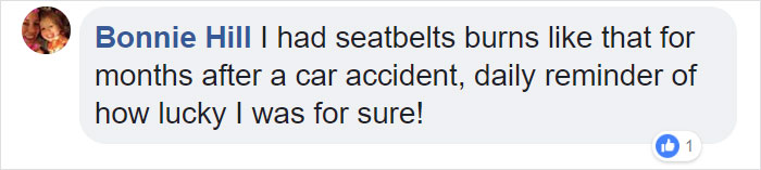 10 Car Crash Survivors Pose Proudly For A Chilling Photo Project To Raise Awareness About Seatbelt Safety 10 Car Crash Survivors Pose Proudly For A Chilling Photo Project To Raise Awareness About Seatbelt Safety