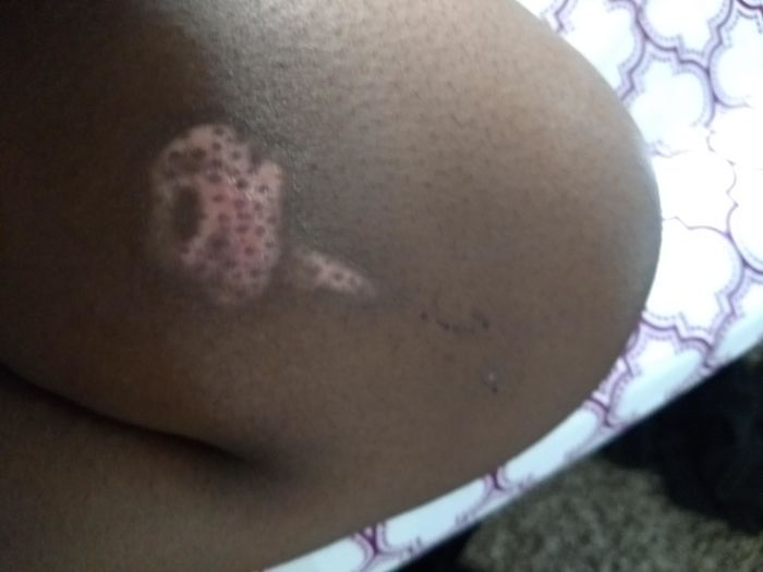 Accidentally Burned My Skin Off On My Knee. The Brown Dots Are My Melanin Coming Back