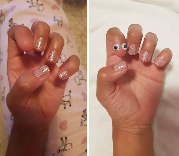 My GF Was Born Without A Nail On A Finger. So Due To Popular Demand, We Put Google Eyes On It