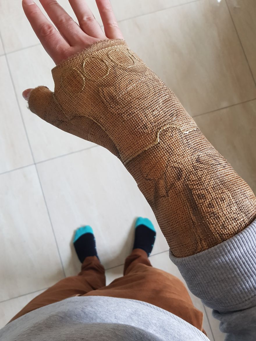 After Breaking My Wrist, I Turned My Plain Cast Into Thanos‘ Infinity Gauntlet After Breaking My Wrist, I Turned My Plain Cast Into Thanos‘ Infinity Gauntlet