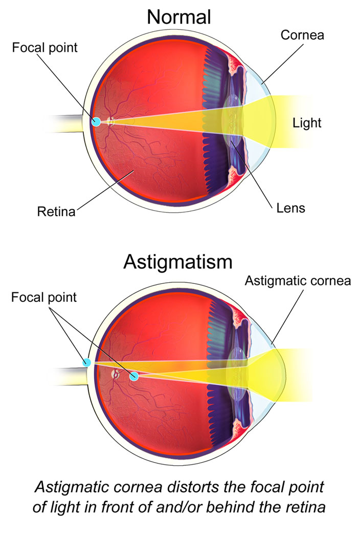 Illustration of a normal and astigmatism eye structure