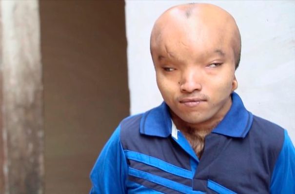Dubbed As &ldquo;Alien&rdquo;, Man With Enlarged Head Disorder Wants Surgery So He Can Find Love