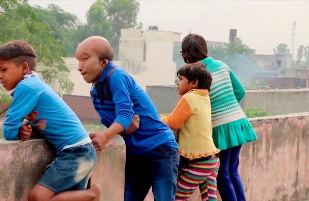 Dubbed As &ldquo;Alien&rdquo;, Man With Enlarged Head Disorder Wants Surgery So He Can Find Love