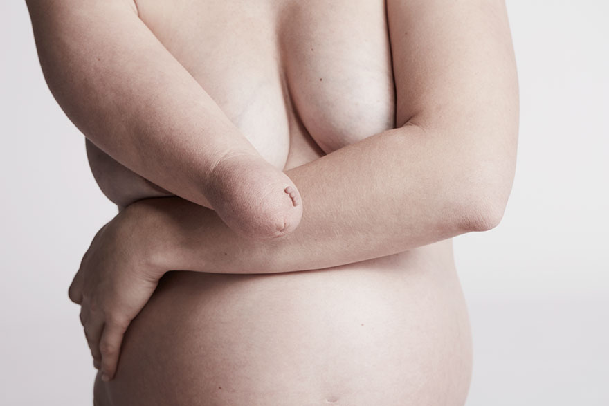 We Photographed 19 People With Limb Differences Aged From 2 To 54 In Body Confidence Shoot We Photographed 19 People With Limb Differences Aged From 2 To 54 In Body Confidence Shoot