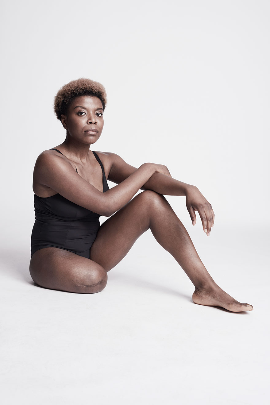 We Photographed 19 People With Limb Differences Aged From 2 To 54 In Body Confidence Shoot