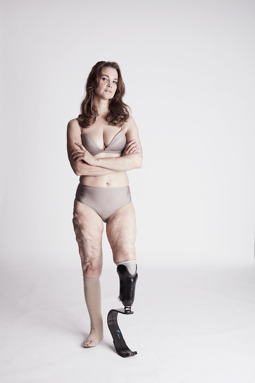 We Photographed 19 People With Limb Differences Aged From 2 To 54 In Body Confidence Shoot We Photographed 19 People With Limb Differences Aged From 2 To 54 In Body Confidence Shoot