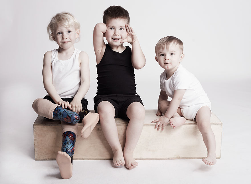 We Photographed 19 People With Limb Differences Aged From 2 To 54 In Body Confidence Shoot We Photographed 19 People With Limb Differences Aged From 2 To 54 In Body Confidence Shoot