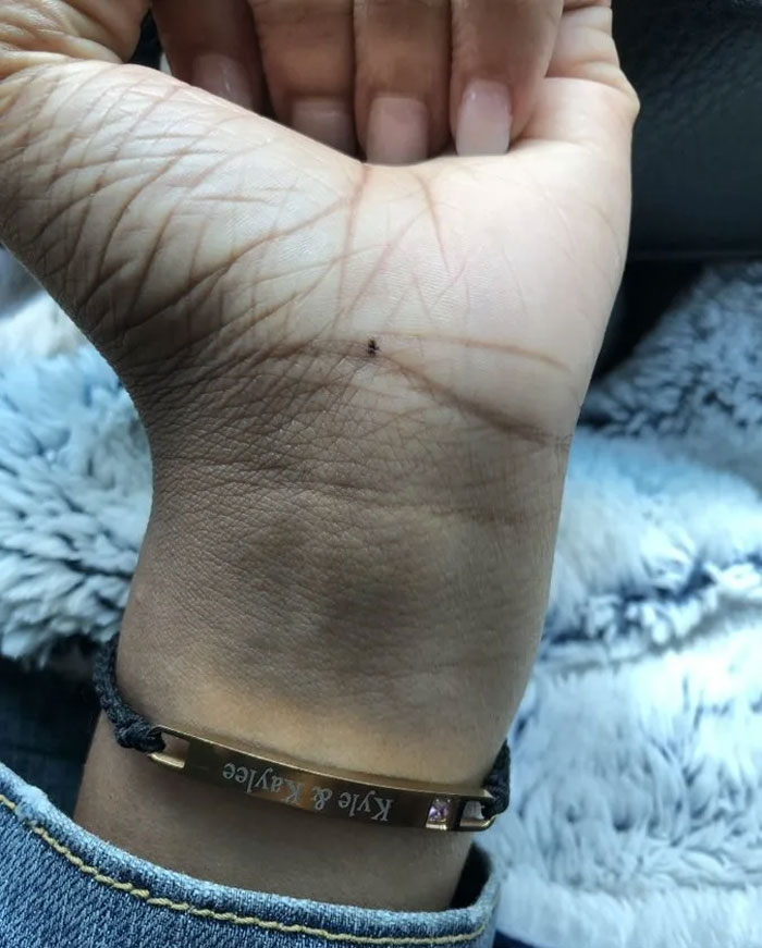 Someone Claims All Women Have A Freckle In The Middle Of Their Wrists, And People Start Freaking Out (23 Pics) Someone Claims All Women Have A Freckle In The Middle Of Their Wrists, And People Start Freaking Out (23 Pics)