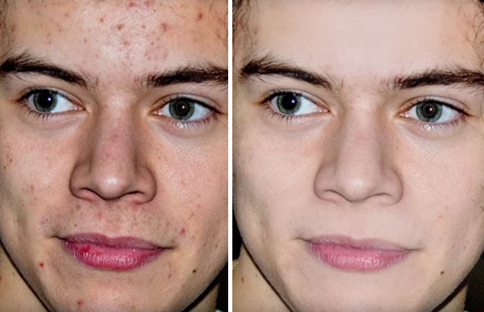 Harry with pimples (left), the same image of Harry only photoshopped (right) Harry with pimples (left), the same image of Harry only photoshopped (right)