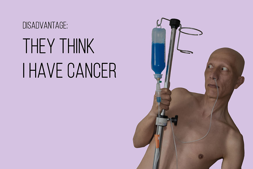 I've Been Living With Alopecia Universalis For 19 Years And I Show The Good And Bad Parts Of It (23 Pics)