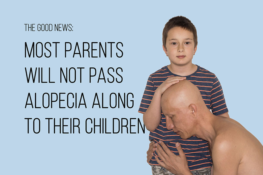 I've Been Living With Alopecia Universalis For 19 Years And I Show The Good And Bad Parts Of It (23 Pics)