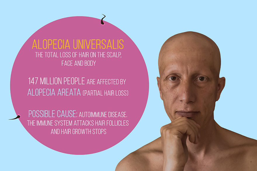 I've Been Living With Alopecia Universalis For 19 Years And I Show The Good And Bad Parts Of It (23 Pics) I've Been Living With Alopecia Universalis For 19 Years And I Show The Good And Bad Parts Of It (23 Pics)