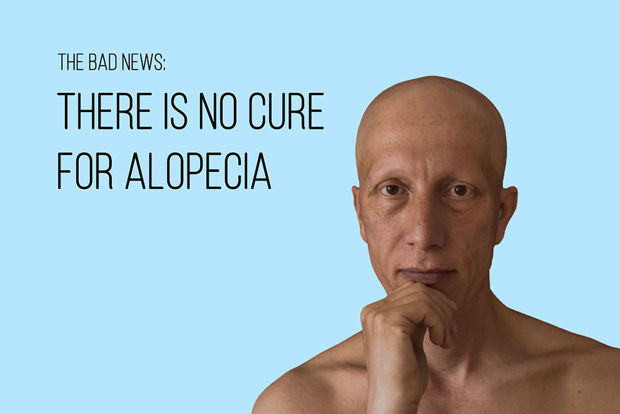 I've Been Living With Alopecia Universalis For 19 Years And I Show The Good And Bad Parts Of It (23 Pics) I've Been Living With Alopecia Universalis For 19 Years And I Show The Good And Bad Parts Of It (23 Pics)