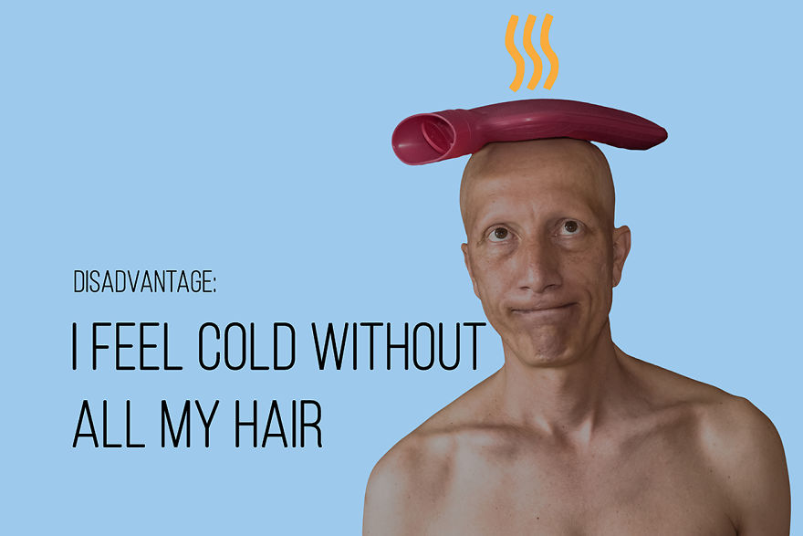 I've Been Living With Alopecia Universalis For 19 Years And I Show The Good And Bad Parts Of It (23 Pics)