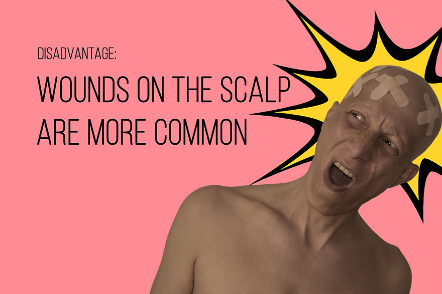 I've Been Living With Alopecia Universalis For 19 Years And I Show The Good And Bad Parts Of It (23 Pics) I've Been Living With Alopecia Universalis For 19 Years And I Show The Good And Bad Parts Of It (23 Pics)