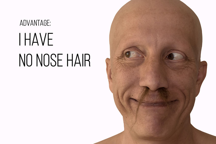 I've Been Living With Alopecia Universalis For 19 Years And I Show The Good And Bad Parts Of It (23 Pics)