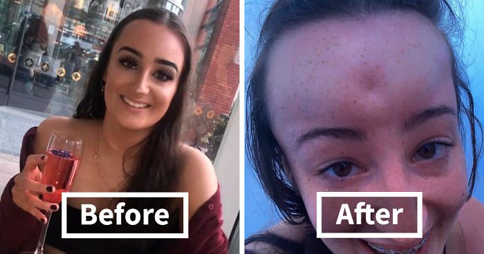 Girl Starts To Look Like An Alien Due To Swelling Head, Does Nothing Until Her Eyes Almost Swell Shut