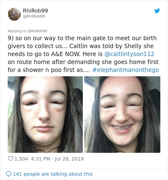 Girl Starts To Look Like An Alien Due To Swelling Head, Does Nothing Until Her Eyes Almost Swell Shut Girl Starts To Look Like An Alien Due To Swelling Head, Does Nothing Until Her Eyes Almost Swell Shut