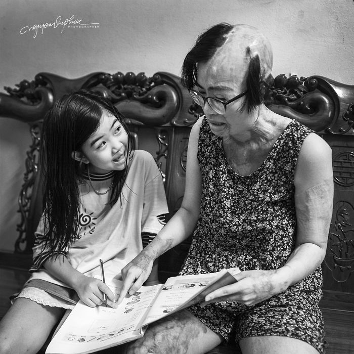 34-Year-Old Mother Survives Her Ex-Husband&rsquo;s Acid Attack And I Want To Share Her Story