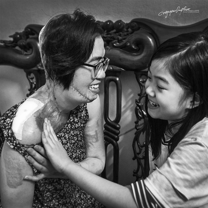 34-Year-Old Mother Survives Her Ex-Husband&rsquo;s Acid Attack And I Want To Share Her Story