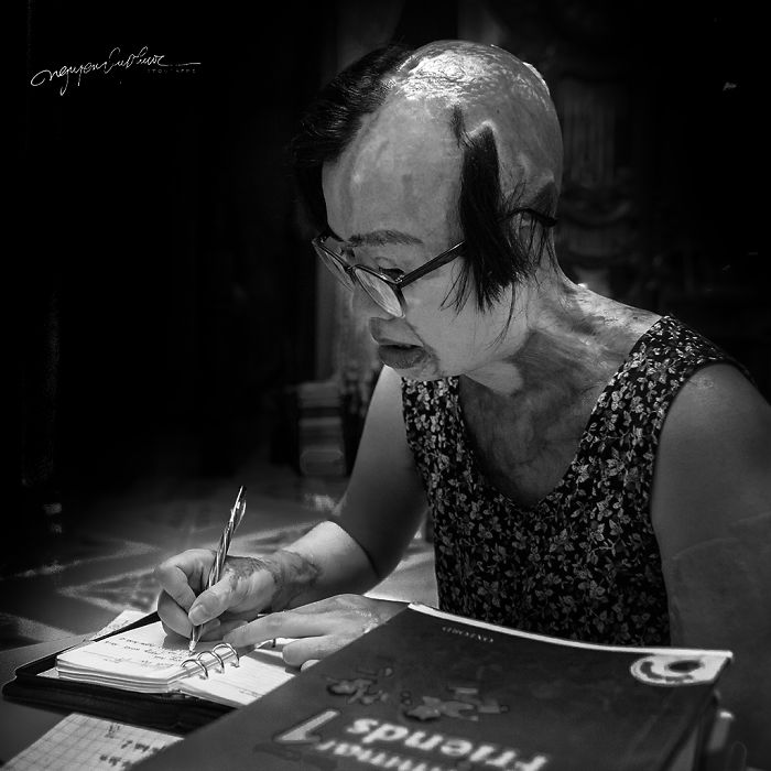 34-Year-Old Mother Survives Her Ex-Husband&rsquo;s Acid Attack And I Want To Share Her Story