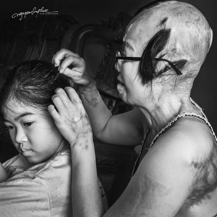 34-Year-Old Mother Survives Her Ex-Husband&rsquo;s Acid Attack And I Want To Share Her Story