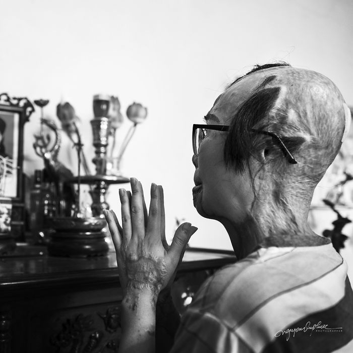 34-Year-Old Mother Survives Her Ex-Husband&rsquo;s Acid Attack And I Want To Share Her Story