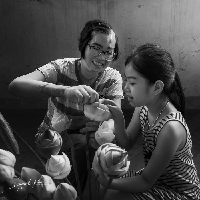 34-Year-Old Mother Survives Her Ex-Husband&rsquo;s Acid Attack And I Want To Share Her Story