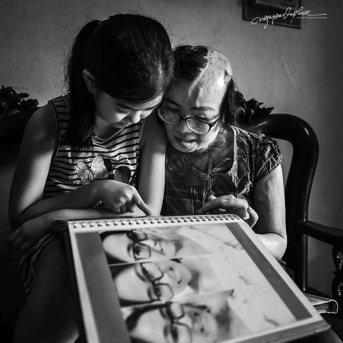 34-Year-Old Mother Survives Her Ex-Husband&rsquo;s Acid Attack And I Want To Share Her Story