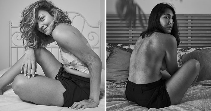 I Show Raw Pictures And Unedited Stories Of People And Their Body Insecurities (19 Pics)