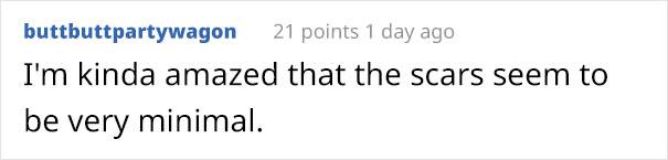 Comment on tattoo removal scars looking minimal after ex-skinhead removes racist tattoos.