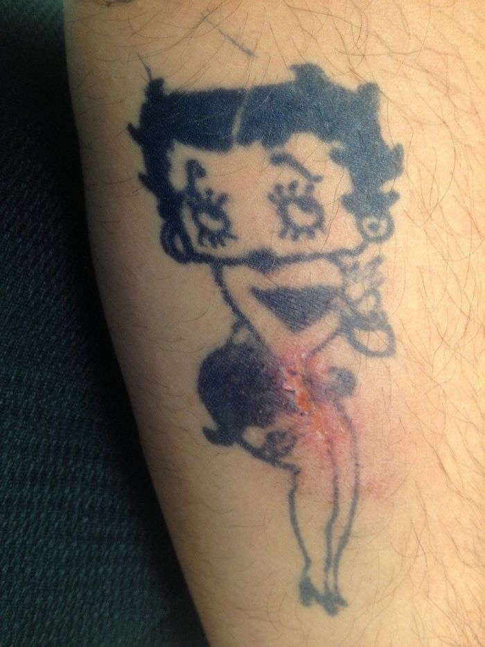 As We Speak, This Doctor Is Laughing At The Irony Of Where My Skin Infection Is On This Henna Tattoo