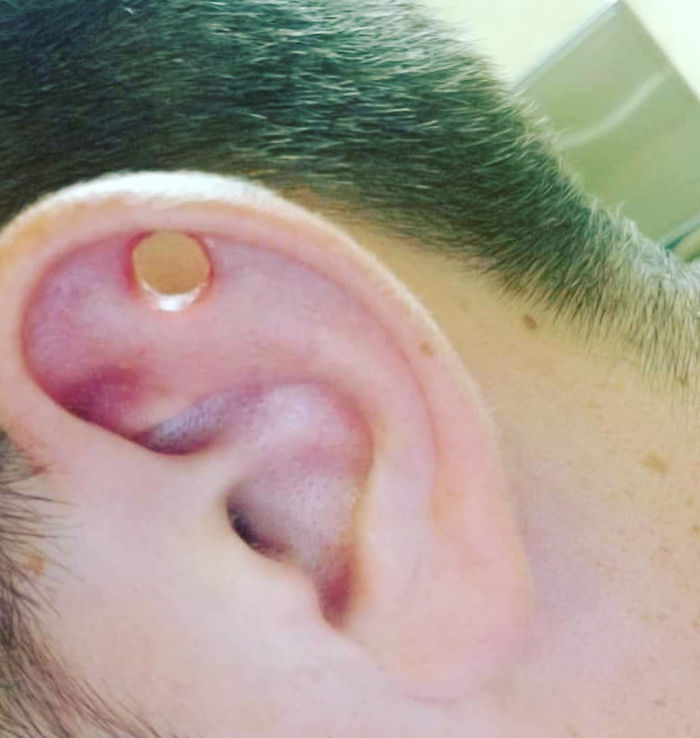 While Drunk 13 Years Ago I Let Someone Take A Leather Punch To My Ear. Turns Out It's Impossible To Close Up Cartilage