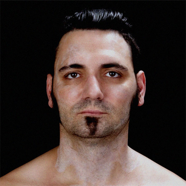 "Ex-skinhead with tattoo removal scars, facing forward, in a black background setting. "Ex-skinhead with tattoo removal scars, facing forward, in a black background setting.