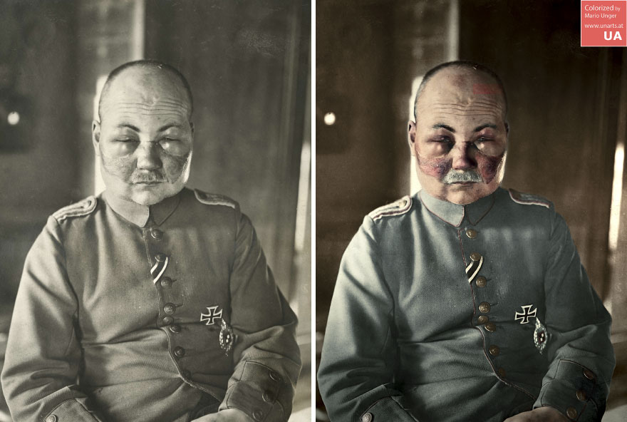 A Frostbitten Lieutenant Foehles Shortly After Landing From A Flight In 1916