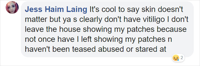 Grandfather With Vitiligo Crochets Dolls To Make Children With This Condition Feel Better Grandfather With Vitiligo Crochets Dolls To Make Children With This Condition Feel Better