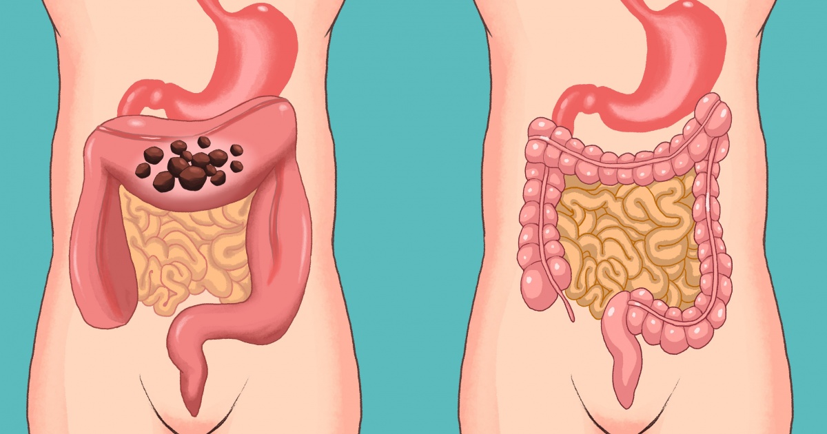 Como desinflamar el intestino