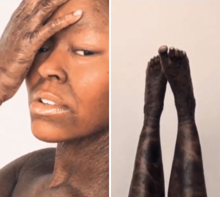 Woman Who Sheds Skin Every Two Weeks Becomes Probably The First Model Who Has This Condition