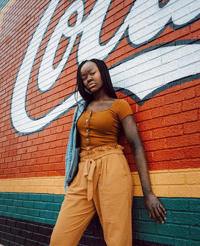 Woman Who Sheds Skin Every Two Weeks Becomes Probably The First Model Who Has This Condition