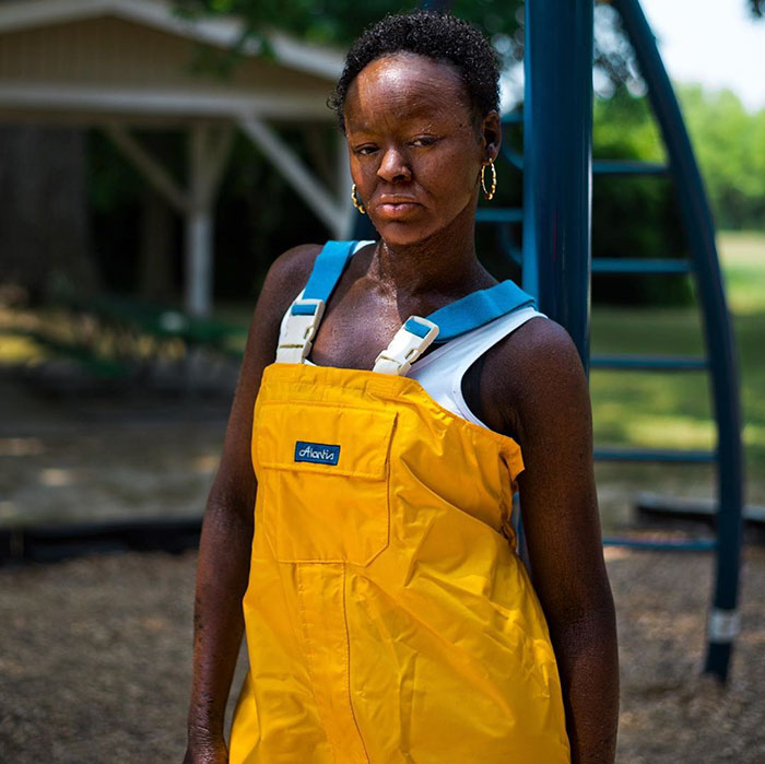 Woman Who Sheds Skin Every Two Weeks Becomes Probably The First Model Who Has This Condition