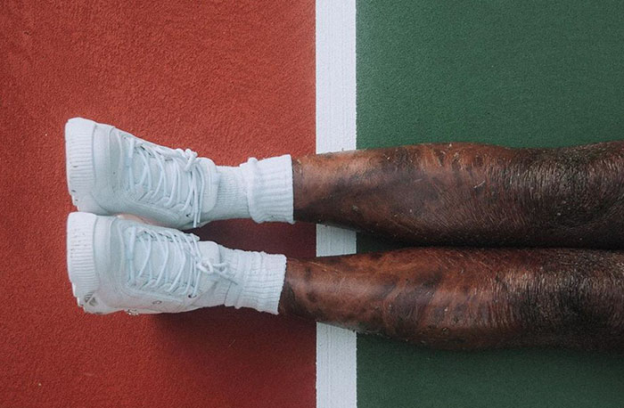 Woman Who Sheds Skin Every Two Weeks Becomes Probably The First Model Who Has This Condition