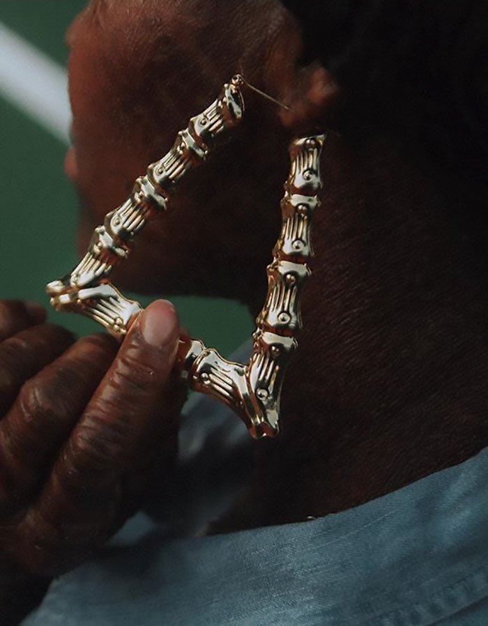 Woman Who Sheds Skin Every Two Weeks Becomes Probably The First Model Who Has This Condition Woman Who Sheds Skin Every Two Weeks Becomes Probably The First Model Who Has This Condition