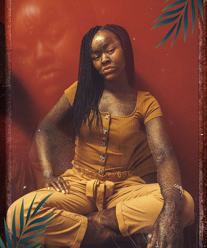 Woman Who Sheds Skin Every Two Weeks Becomes Probably The First Model Who Has This Condition